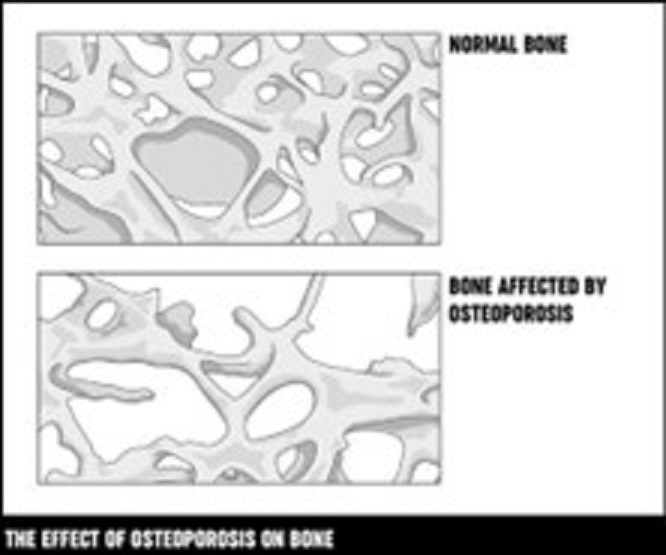 Osteoarthritis Vs Osteoporosis Difference Between Osteoarthritis And